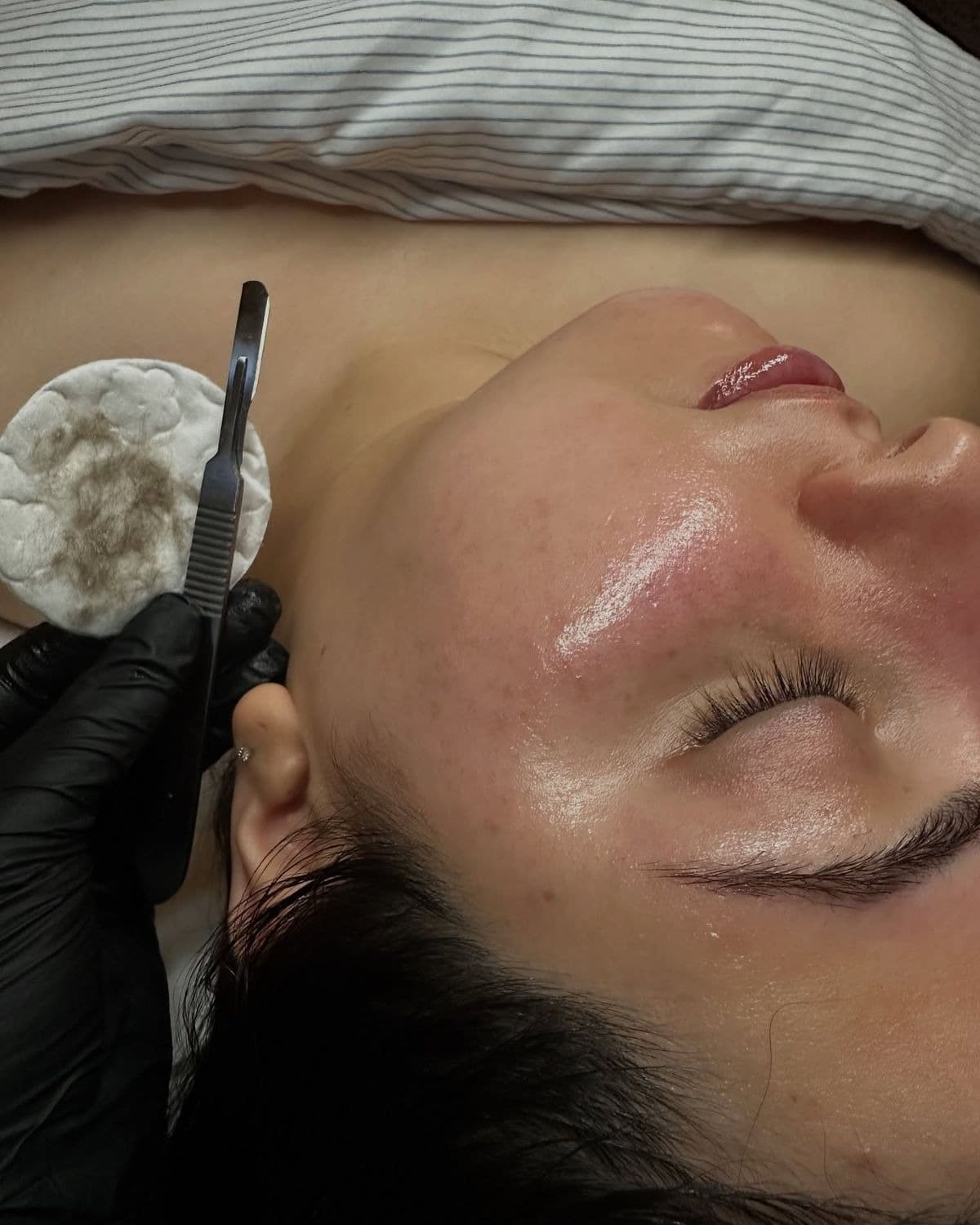 Dermaplaning 4D